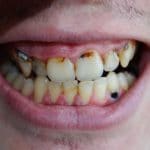 Bad Teeth from Drugs- Miami, Florida