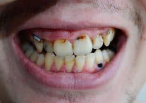 Bad Teeth from Drugs